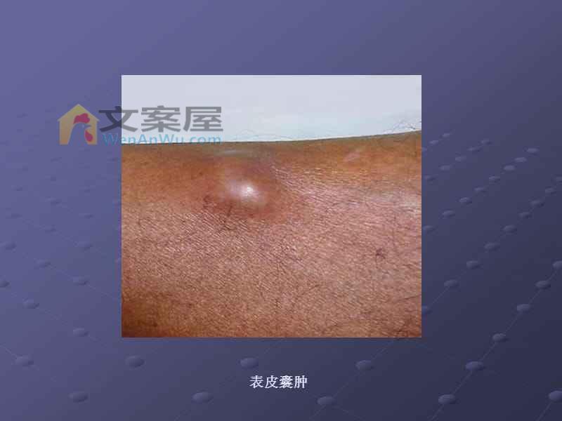 《囊肿》电影解说文案